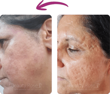 תמונה לפני ואחרי טיפול בעור הפנים