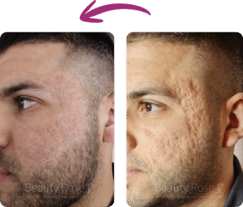 תמונה לפני ואחרי טיפול בעור הפנים